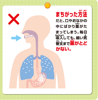 まちがった方法だと、口やおなかの中にばかり薬がたまってしまう。毎日吸入しても、細い気管支まで薬がとどかない。