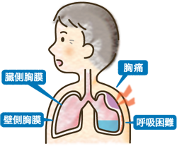 中皮腫について 中皮腫とその診断 治療 中皮腫とは 診断 治療から公的制度まで アスベスト 石綿 健康被害の救済 独立行政法人環境再生保全機構