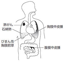 アスベスト 石綿 関連疾患 アスベスト 石綿 による健康被害 アスベスト 石綿 とは アスベスト 石綿 健康被害の救済 独立行政法人環境再生保全機構