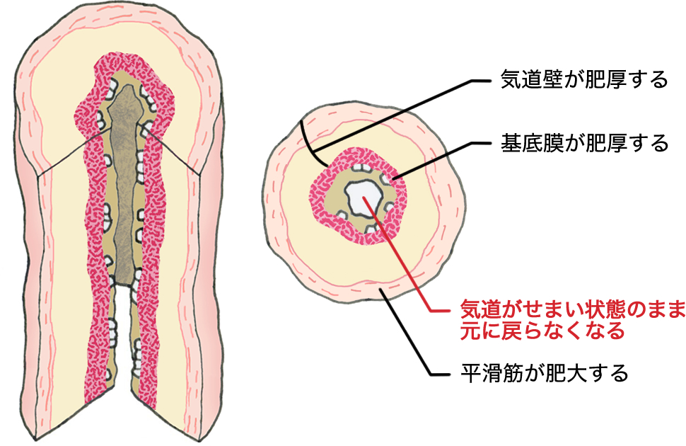 炎症が続くことにより、気道壁や基底膜が肥厚、平滑筋が肥大し、気道がせまい状態のまま戻らなくなります