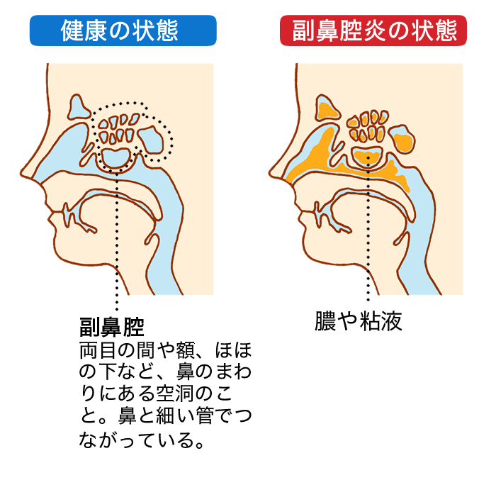 副鼻腔炎は、副鼻腔とよばれる両目の間や額、ほほの下など、鼻のまわりにある空洞に、膿や粘液がたまってしまう状態のことです。