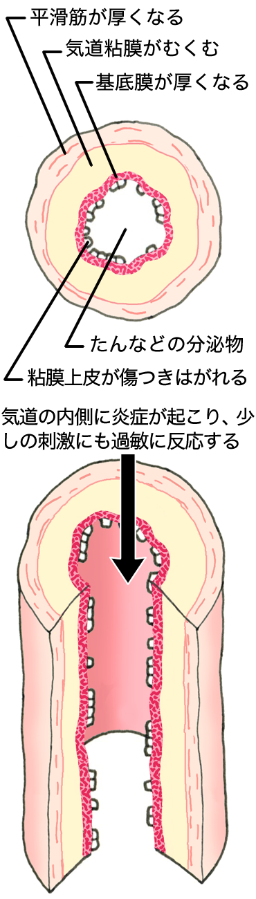 ぜん息患者さんの気道は、炎症により気道上皮が傷つき、はがれて敏感になり、少しの刺激にも過敏に反応します。気道粘膜がむくみ、たんなどの分泌物も出るため、気道がせまくなり空気が通りにくい状態です