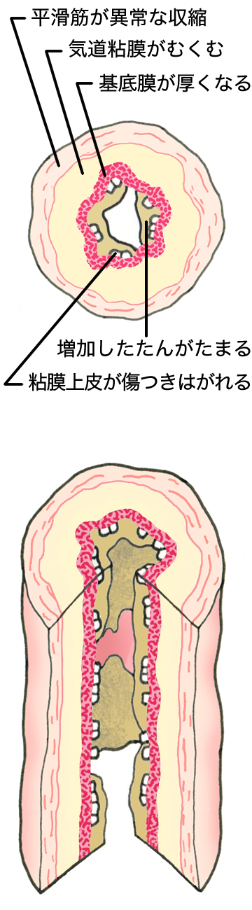 ぜん息発作時の気道は、増加したたんがたまり、平滑筋が異常に収縮して気道が極端にせまくなっている状態です