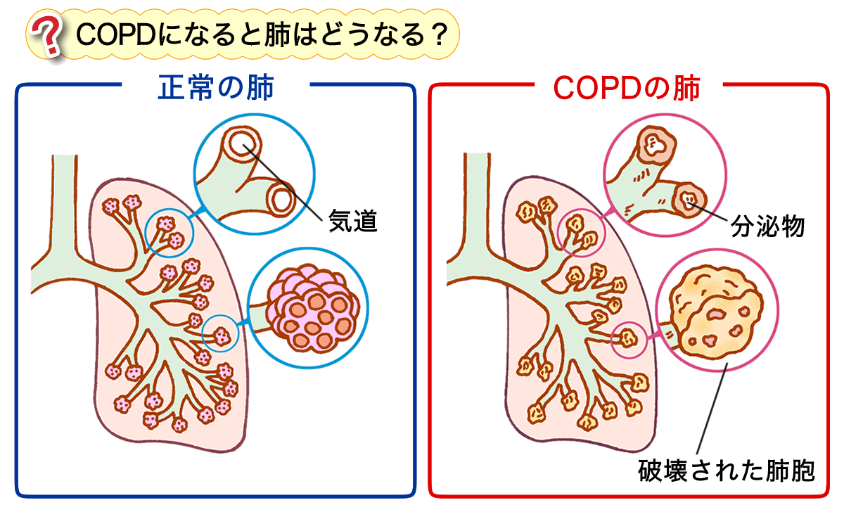 図解：COPDになると肺はどうなる？　COPDの肺では、気道に炎症が起こり、たんなどの分泌物によって狭くなったり、肺胞が壊れたりします。