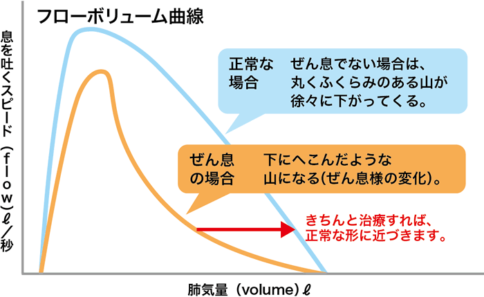 図 フローボリューム曲線 正常な場合の曲線は、丸いふくらみのある山が徐々に下がってきます。一方、ぜん息の場合の曲線は、下にへこんだような山になります。きちんと治療すれば、正常な形に近づきます。