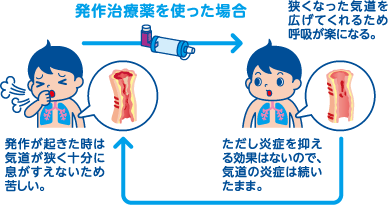 発作が起きたときに、発作治療薬を使った場合は狭くなった気道を広げてくれるため呼吸が楽になります。ただし炎症を抑える効果はないので、気道の炎症は続いたままとなり、炎症が鎮まらない限りまた発作が起こります。