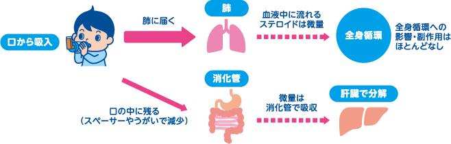 吸入したステロイド薬の一部が肺に届きますが、血液中に流れるステロイドは微量で全身循環への影響・副作用はほとんどありません。また、吸入ステロイド薬の一部は口の中に残って胃腸で吸収されますが、ごくわずかな量で、すぐに肝臓で分解されてしまうため内服薬のような副作用は起こりません。