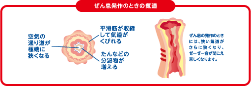 ぜん息の発作のときには、狭い気道がさらに狭くなり、ゼーゼー音が聞こえ苦しくなります。