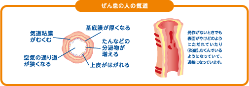 ぜん息の人の気道は、発作がないときでも表面がやけどのようにただれていたり（炎症）、むくんでいるようになっていて、過敏になっています。