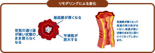 リモデリングとは…気道壁が厚くなって気道の弾力性がなくなり、気道が狭い状態のまま元に戻りにくくなってしまいます。