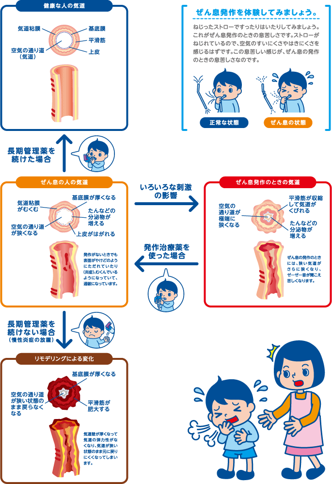 ぜん息の人の気道は、発作がないときでも表面がやけどのようにただれていたり（炎症）、むくんで厚くなっていて、健康な人より気道が狭くなっています。長期管理薬を続け正常な状態を保ちましょう。