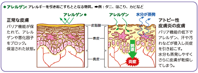 正常な皮膚　バリア機能が保たれて、アレルゲンや悪化因子をブロック。保湿された状態。＊アレルゲン：アレルギーを引き起こすもととなる物質。➡例：ダニ、ほこり、カビなど　アトピー性皮膚炎の皮膚　バリア機能の低下でアレルゲン、汗や汚れなどが侵入し炎症を引き起こす。水分も蒸発しやすくさらに皮膚が乾燥してしまう。