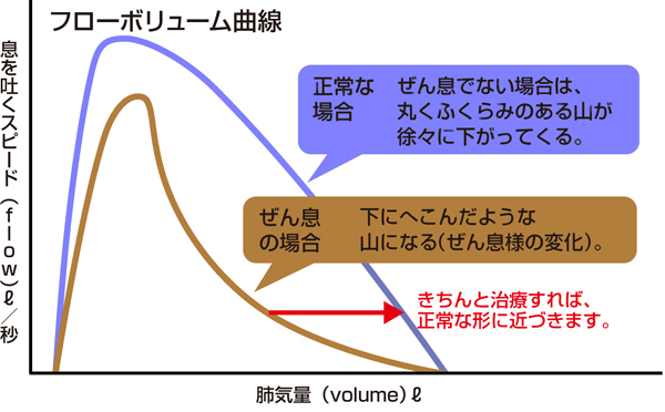 呼吸機能検査の結果をグラフで表したのが、フローボリューム曲線です。縦軸が息を吐くスピード、横軸が肺気量です。正常な場合は、丸くふくらみのある山が徐々に下がってくる曲線を描きますが、ぜん息の場合は下にへこんだような山（ぜん息様の変化）になります。
