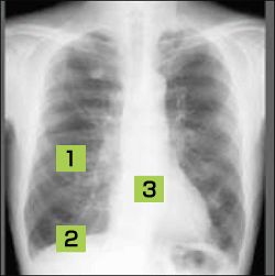 画像検査 Copd 特集 47号 Web版すこやかライフ ぜん息などの情報館 大気環境 ぜん息などの情報館 独立行政法人環境再生保全機構