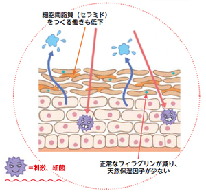 アトピー性皮膚炎の皮膚の場合は、細胞間脂質（セラミド）をつくる働きも低下し、正常なフィラグリンが減り、天然保湿因子が少ないため、刺激や細菌による炎症が起きやすい。