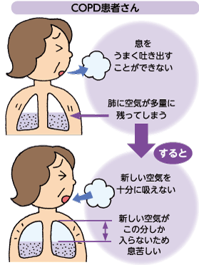 COPD患者さんは息をうまく吐き出すことができないので、肺に空気が多量に残ってしまう。すると、吐き出した分しか新しい空気が入らないため息苦しい