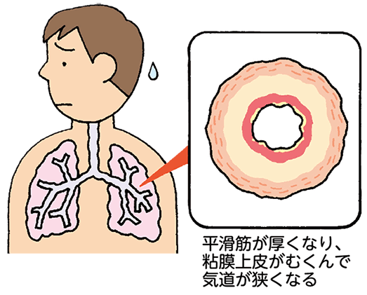 ぜん息の人の気管支は、平滑筋が厚くなり、粘膜上皮がむくんで気道が狭くなる