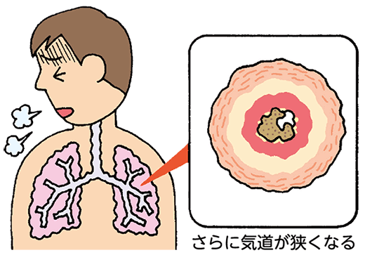 発作時の気管支は、さらに気道が狭くなる