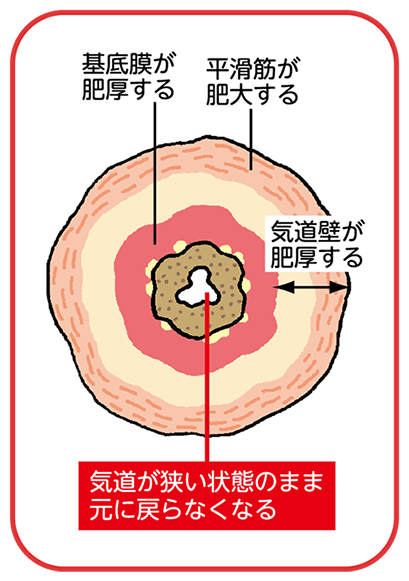 基底膜が肥厚し、平滑筋が肥大し、気道壁が肥厚する。気道が狭い状態のまま元に戻らなくなる。