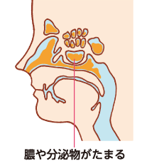 炎症が起き、膿や分泌物がたまっている副鼻腔の断面図