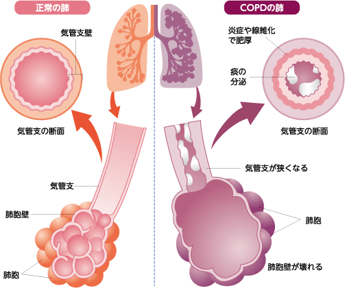 Copdってどんな病気ですか ぜん息などの情報館 大気環境 ぜん息などの情報館 独立行政法人環境再生保全機構