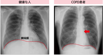 Copdかも どうしたらわかりますか ぜん息などの情報館 大気環境 ぜん息などの情報館 独立行政法人環境再生保全機構