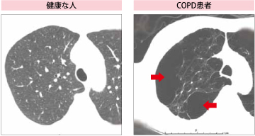 Copdかも どうしたらわかりますか ぜん息などの情報館 大気環境 ぜん息などの情報館 独立行政法人環境再生保全機構