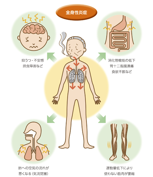 全身性炎症　抑うつ・不安感摂食障害など　消化管機能の低下胃十二指腸潰瘍食欲不振など　肺への空気の流れが悪くなる（気流閉塞）　運動量低下により使わない筋肉が萎縮