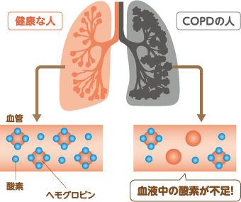 健康な人とCOPDの人の血液中酸素