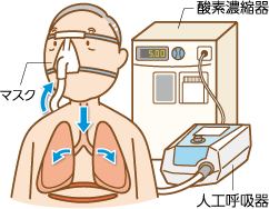 息を吸うとき（NPPV の場合）