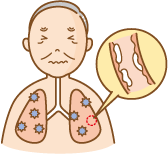 COPDだとなぜ痰が増える？