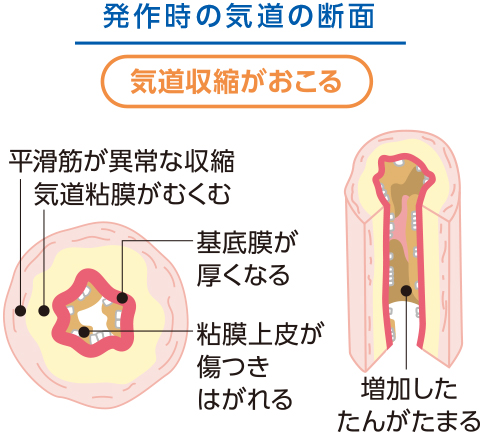 発作時の気道の断面