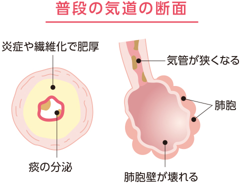 普段の気道の断面