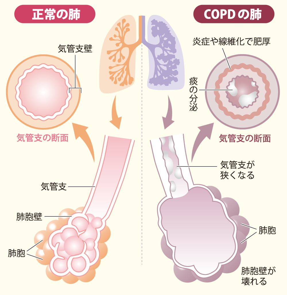 イラスト1 「正常の肺」と「COPDの肺」を比較するイラスト。COPDの肺では気管支が狭くなったり、肺胞壁が壊れる様子が描かれています。